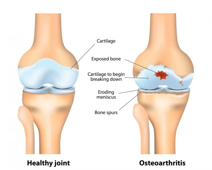 Diagramm eines gesunden synovialen Gelenks vs. frühe Phase der Arthrose